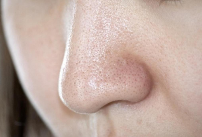 科 皮膚 鼻 いちご 美容 【医師監修】「いちご鼻」の治療に効果的な皮膚科のレーザー治療
